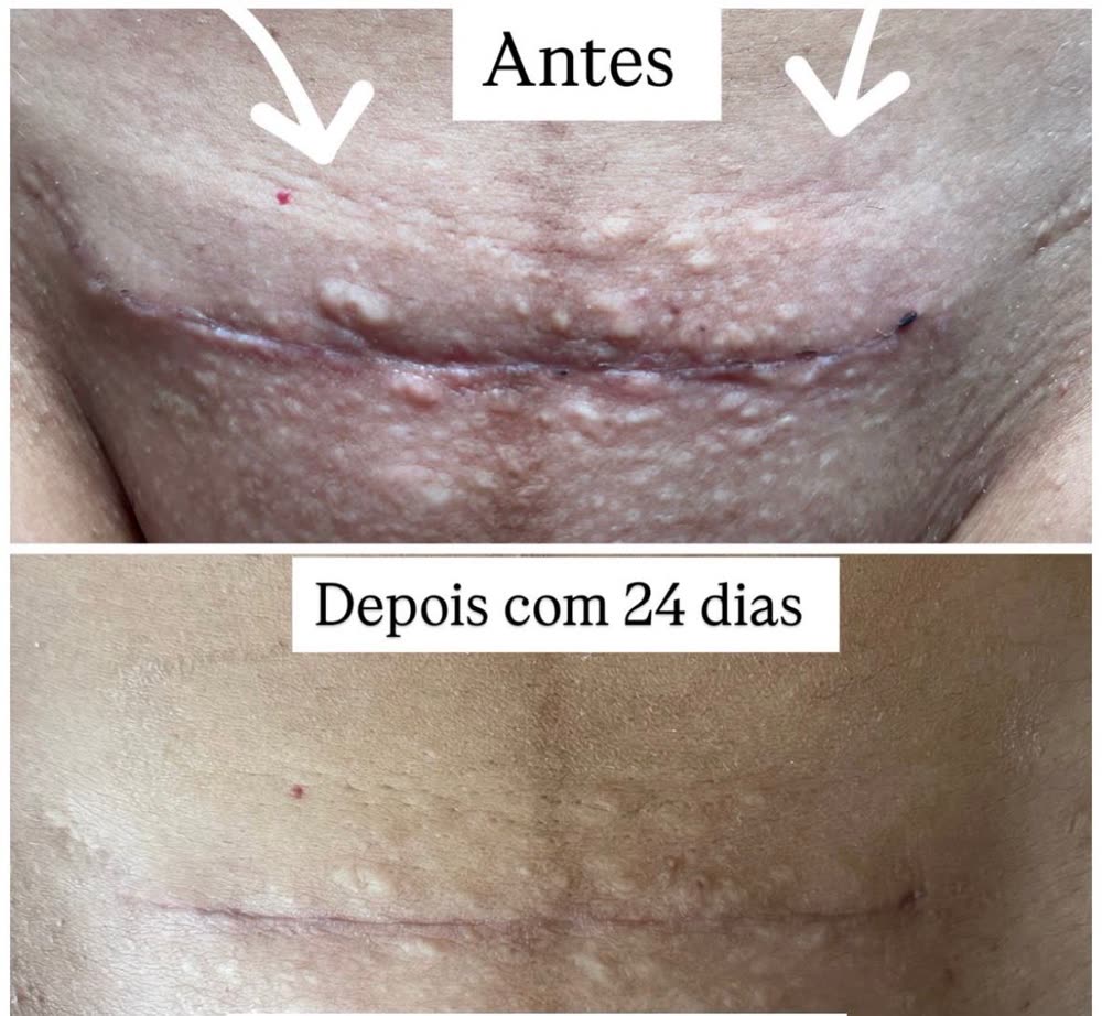 Antes e depois com 24 dias: cicatriz de cesárea inflamada e depois mais lisa e discreta