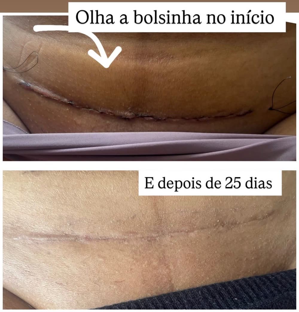 Bolsinha acima da cicatriz no início e, depois de 25 dias, região mais plana