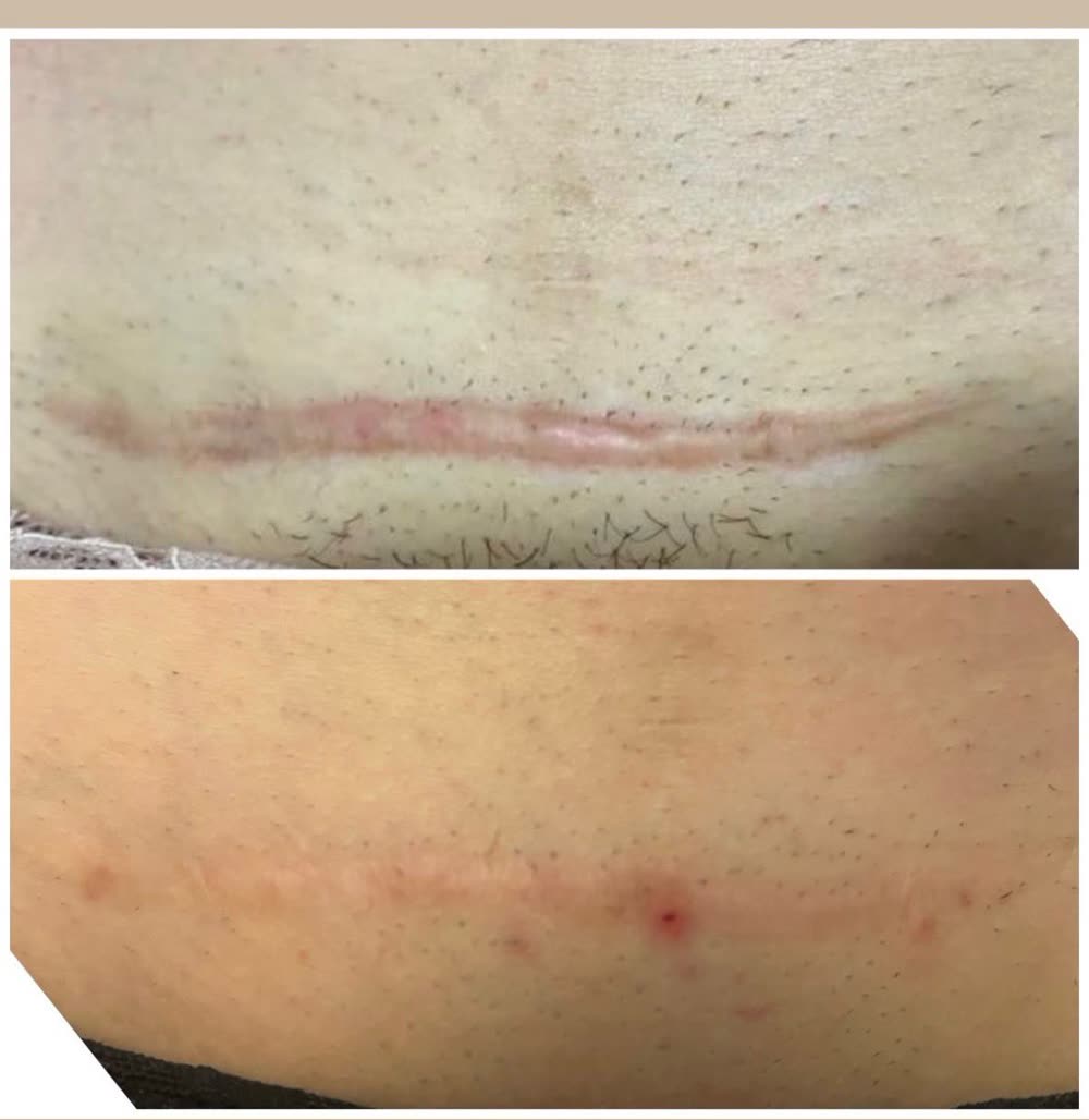 Cicatriz avermelhada e espessa antes e, depois, mais clara e plana