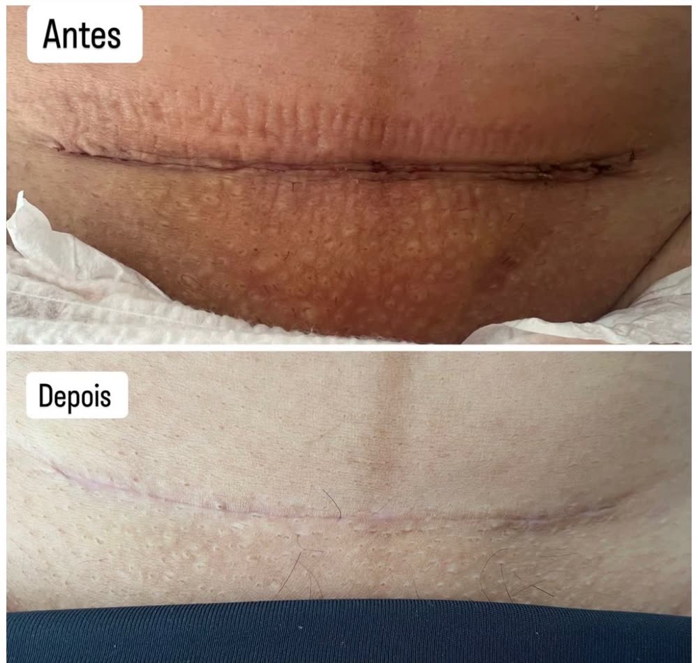 Antes e depois: cicatriz recente com pele marcada e depois linha fina