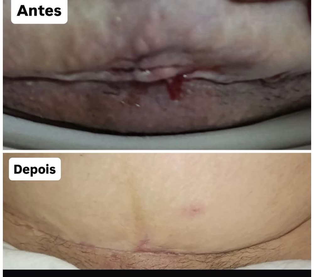 Antes e depois: cicatriz com abertura e depois cicatrizada