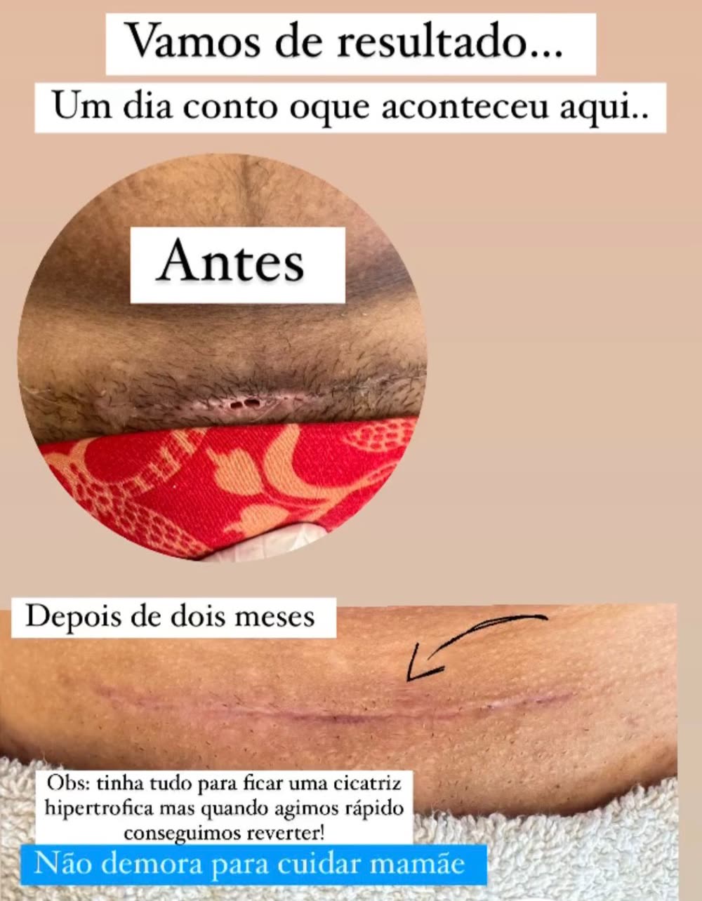 Antes e depois de dois meses: cicatriz com tendência a ficar hipertrófica e depois mais fina