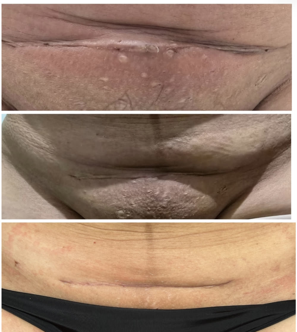 Três fotos da evolução de uma cicatriz de cesárea até ficar discreta