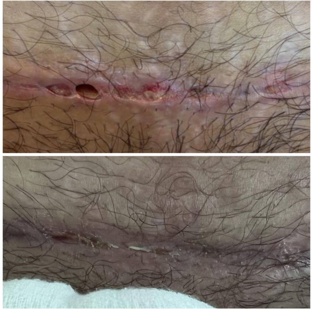 Cicatriz com aberturas antes e depois em fechamento