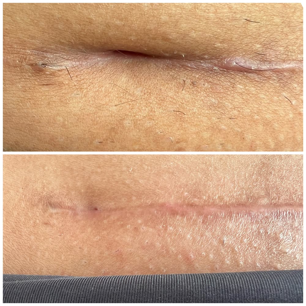 Cicatriz afundada e repuxada antes e depois mais nivelada